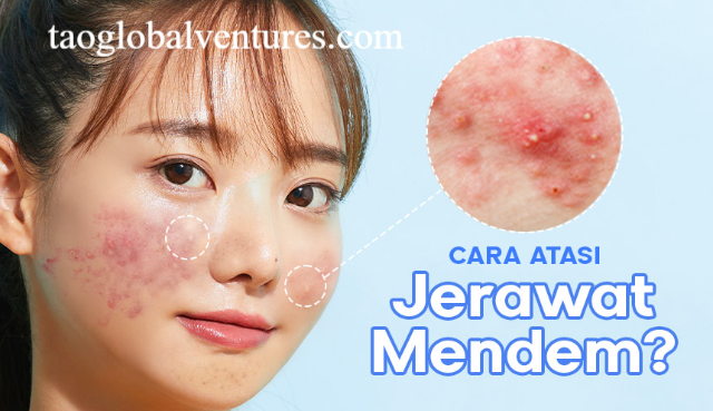 Cara Mengatasi Jerawat dengan Perawatan yang Tepat dan Konsisten