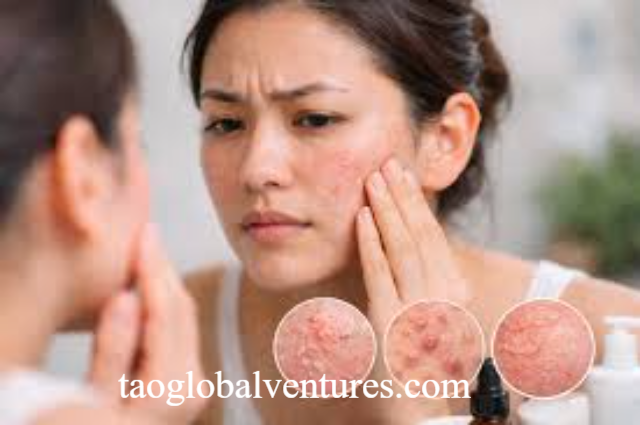 Teknik Pelepasan Retinol Berkala Mempercepat Pembaruan Sel Kulit Guna Menghalau Efek Kemerahan Wajah
